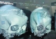 ‘Şarlatan’ bir ‘şifacı’ 19 yaşındaki kızın kafatasına 22 iğne enjekte etti. İğneler ameliyatla çıkarıldı