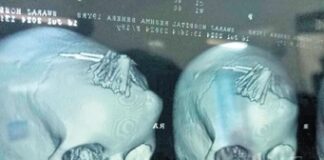 ‘Şarlatan’ bir ‘şifacı’ 19 yaşındaki kızın kafatasına 22 iğne enjekte etti. İğneler ameliyatla çıkarıldı