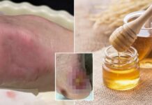 Bir adamın enfekte ayağı kurtçuk, bal ve insan plasentası kullanarak iyileştirildi!