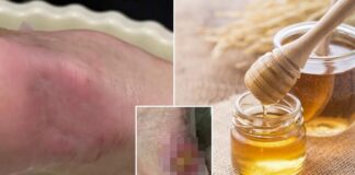 Bir adamın enfekte ayağı kurtçuk, bal ve insan plasentası kullanarak iyileştirildi!