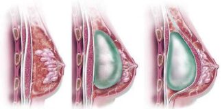 Araştırma; Meme büyütme ameliyatları kadınların cinsel hayatlarını ve ruhsal sağlıklarını iyileştiriyor
