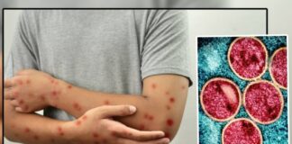 Avrupa’da Maymun Çiçeği alarmı seviyesi yükseltildi