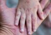 Mpox (Maymun Çiçeği) hakkında bilinmesi gereken her şey…