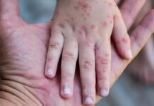 Mpox (Maymun Çiçeği) hakkında bilinmesi gereken her şey…