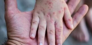 Mpox (Maymun Çiçeği) hakkında bilinmesi gereken her şey…