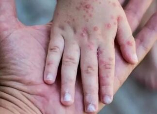 Mpox (Maymun Çiçeği) hakkında bilinmesi gereken her şey…