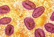 Afrika’da çıktı Pasifik’te de görüldü. Filipinlerde Maymun Çiçeği vakası saptandı