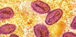 Afrika’da çıktı Pasifik’te de görüldü. Filipinlerde Maymun Çiçeği vakası saptandı