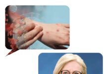 “Maymun çiçeği virüsü için bir tedavi bulunmuyor; ancak, kapanmaya da ihtiyaç yok”