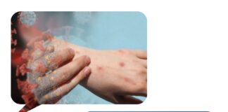 “Maymun çiçeği virüsü için bir tedavi bulunmuyor; ancak, kapanmaya da ihtiyaç yok”