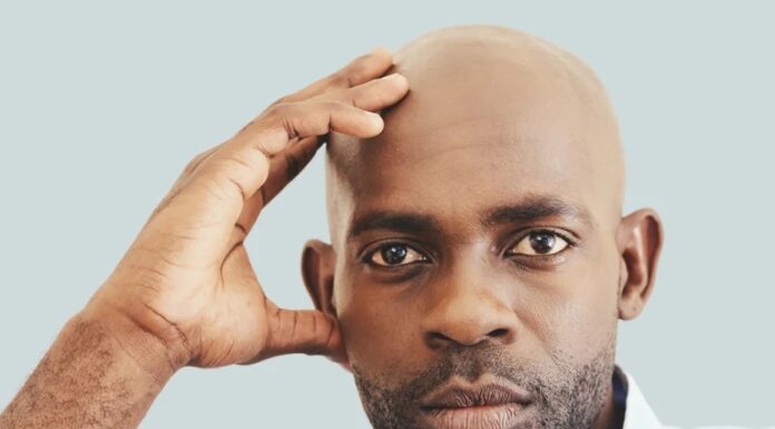 Saç dökülmesiyle mücadelede en son yöntemler.