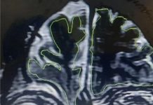 Sürekli burnu akan 20 yaşındaki adamın beyninin dışarı fırladığı ve ‘sızdığı’ anlaşıldı.