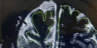 Sürekli burnu akan 20 yaşındaki adamın beyninin dışarı fırladığı ve ‘sızdığı’ anlaşıldı.