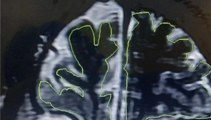 Sürekli burnu akan 20 yaşındaki adamın beyninin dışarı fırladığı ve ‘sızdığı’ anlaşıldı.