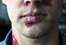 Uzmanlar Türkiye’de HIV virüsündeki artışa dikkat çektiler…’Bunların sadece yarısı HIV ile enfekte olduğunu biliyor’