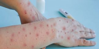 DSÖ: Maymun çiçeği virüsü, acil durumu oluşturmaya devam ediyor.