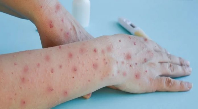 DSÖ: Maymun çiçeği virüsü, acil durumu oluşturmaya devam ediyor.