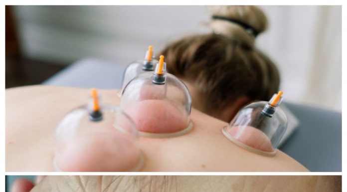 Aile hekimleri hacamat ve akupunktur gibi geleneksel hizmetleri de verecek .