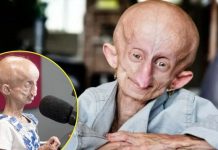 4 milyonda 1 görülüyor. Çaresiz hastalığı nedeniyle 19 senede 152 yaşına geldi, yaşamını yitirdi!