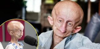 4 milyonda 1 görülüyor. Çaresiz hastalığı nedeniyle 19 senede 152 yaşına geldi, yaşamını yitirdi!