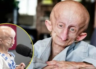 4 milyonda 1 görülüyor. Çaresiz hastalığı nedeniyle 19 senede 152 yaşına geldi, yaşamını yitirdi!