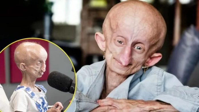 Progeria hastalığı