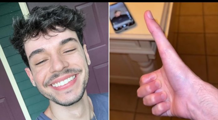 Yaklaşık 13 santimlik dünyanın en büyük baş parmağına sahip adam,en çok cep telefonu kullanırken zorluk çekiyor.