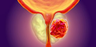 Prostat kanseri testinde çığır açan uygulama: Evde tükürük testi!