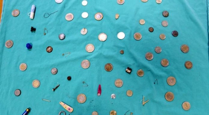 Profesörden sıra dışı koleksiyon. Para, toka, çivi, çatal iğne, küpe, yüzük, karabina, pil, oyuncak; Hepsi mideden çıktı!