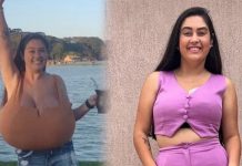 Sadece 300 kişide görülen hastalık: Göğüsleri bir kaç ayda 12 kiloya ulaştı