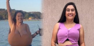 Sadece 300 kişide görülen hastalık: Göğüsleri bir kaç ayda 12 kiloya ulaştı