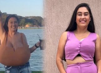 Sadece 300 kişide görülen hastalık: Göğüsleri bir kaç ayda 12 kiloya ulaştı
