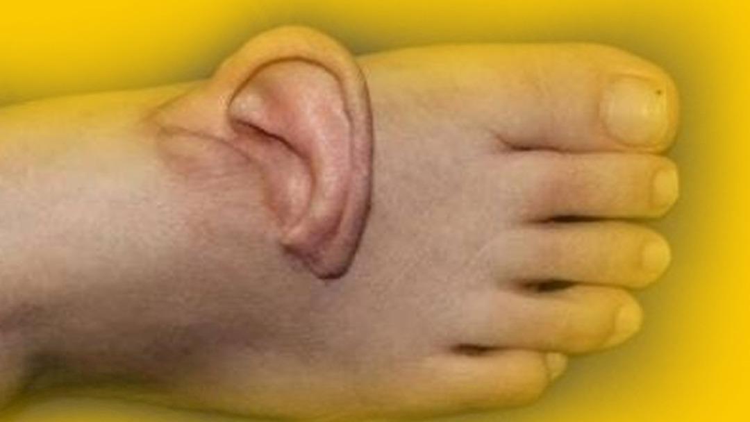 Benzeriz bir olay: Kulağını 5 ay ayağında taşıdı