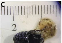 Kadın, hapşırınca burnundan 2,5 cm uzunluğunda 10 solucan çıktı! Doktorlar ‘akıl almaz’ vaka karşısında şaşkına döndü.