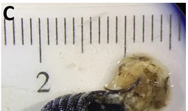 Kadın, hapşırınca burnundan 2,5 cm uzunluğunda 10 solucan çıktı! Doktorlar ‘akıl almaz’ vaka karşısında şaşkına döndü.